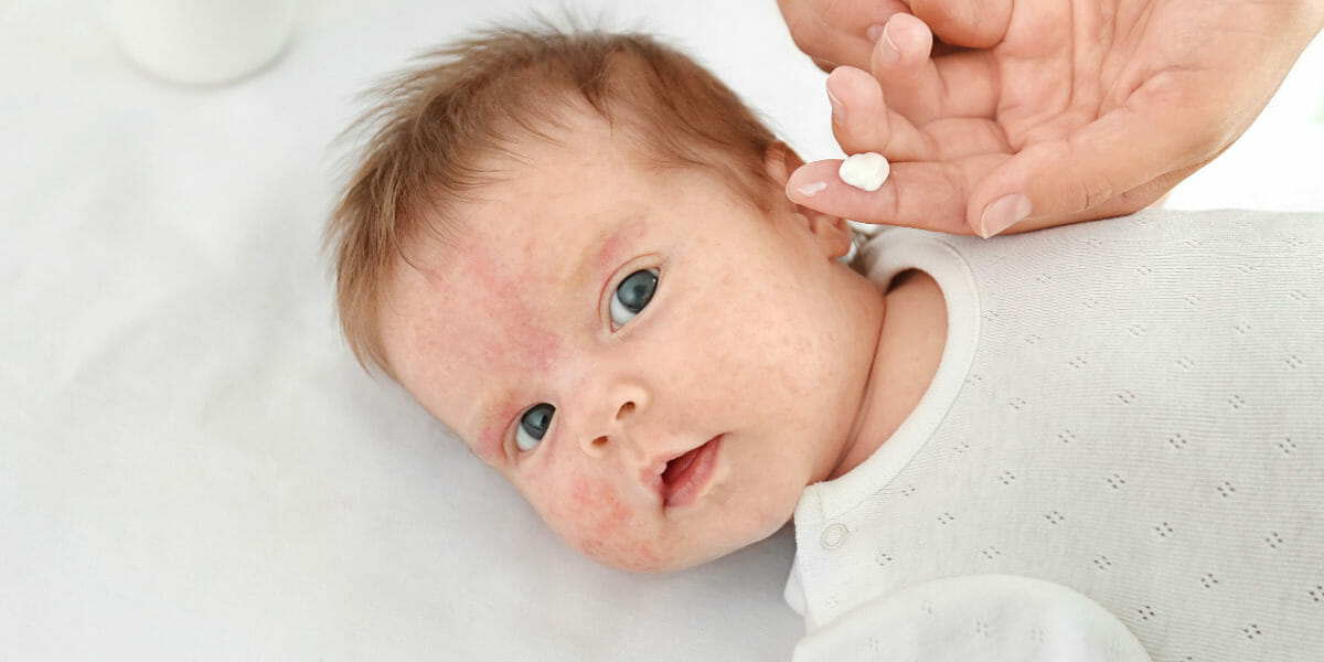 bebe-alergie-a-la-peau-en-traitement