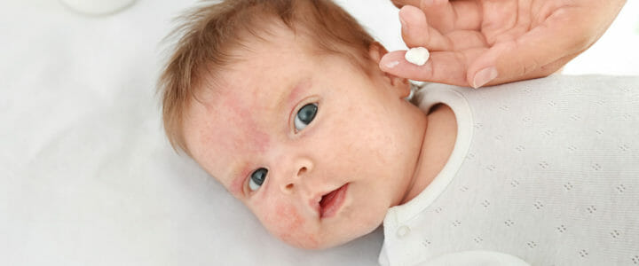 bebe-alergie-a-la-peau-en-traitement